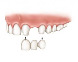 Porcelán hid. Híd pótlás